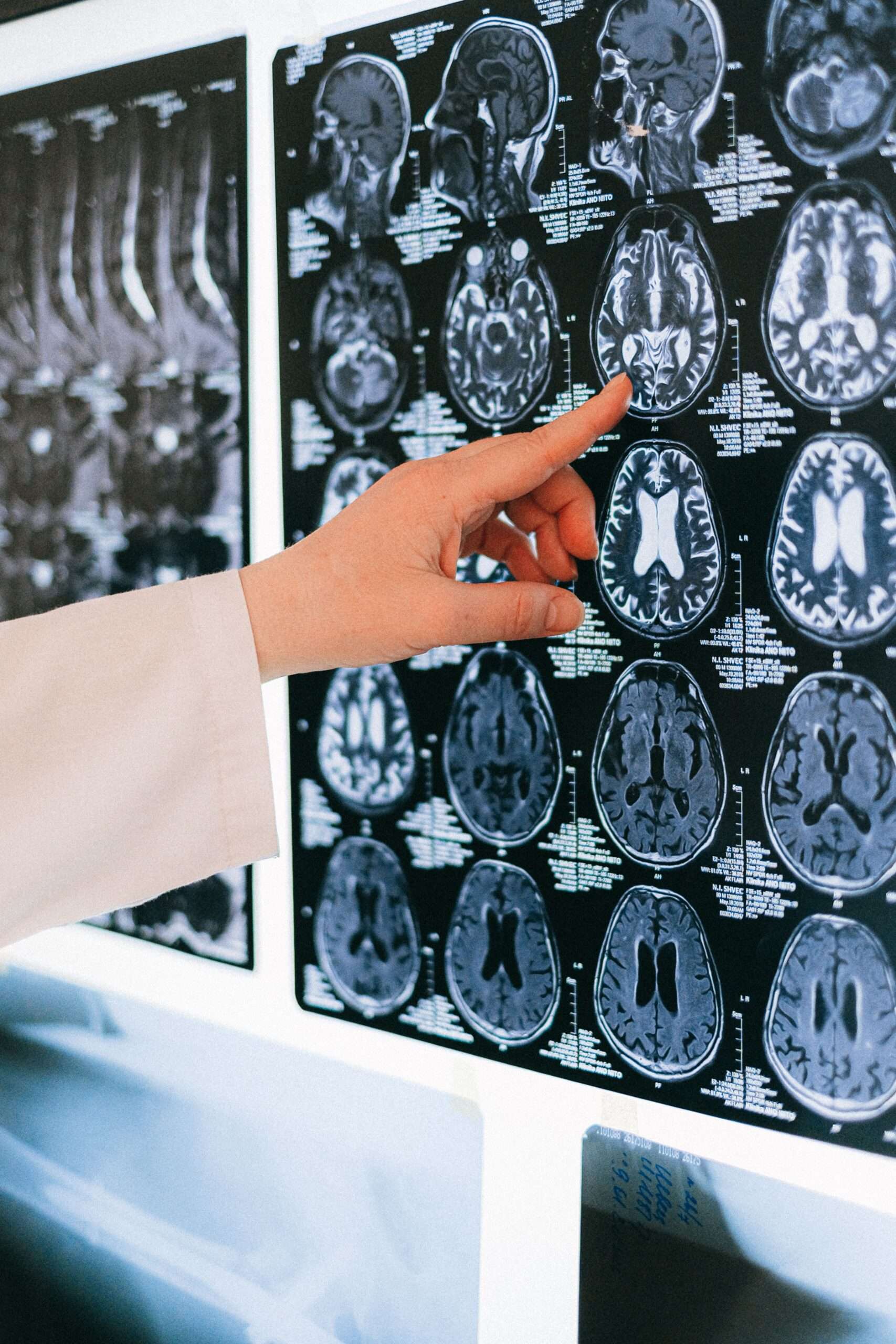  ثورة في الكشف المبكر عن الأمراض العصبية في مستشفى جامعة لوفين